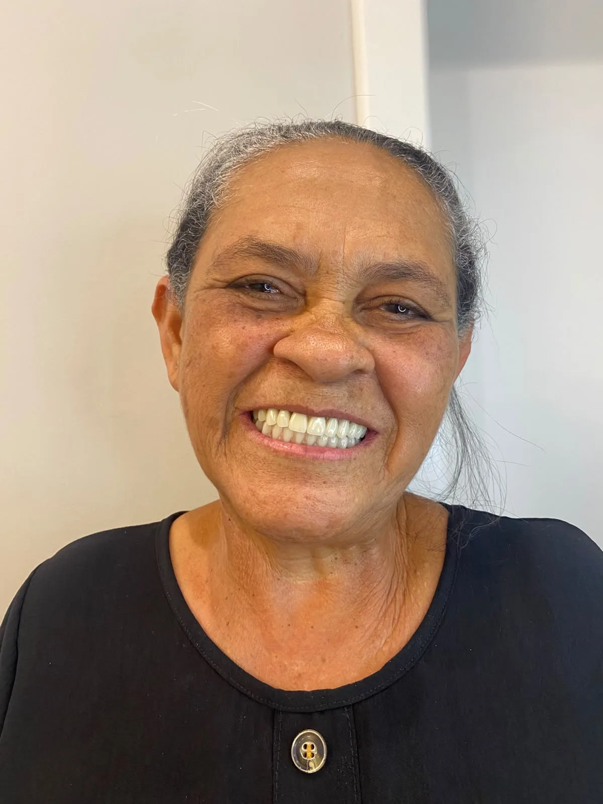 Paciente idosa sorrindo de perto, mostrando o sorriso reabilitado